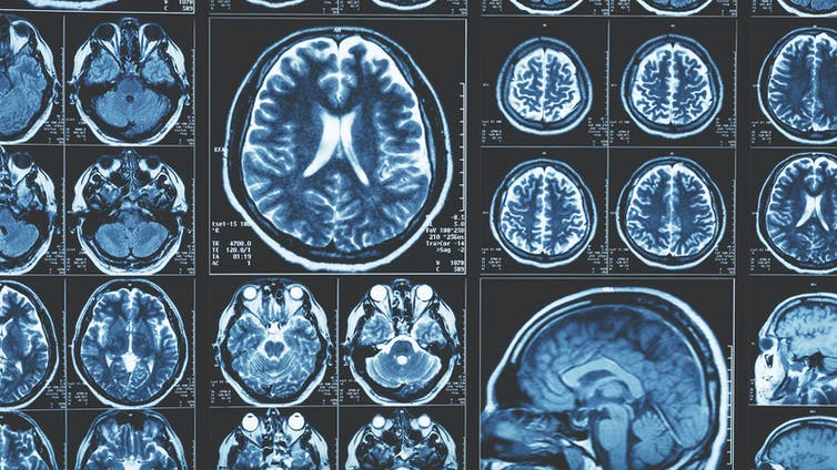 MRI images of the human brain.