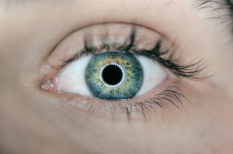 A close up photo of an eye with a bright white halo around the pupil.